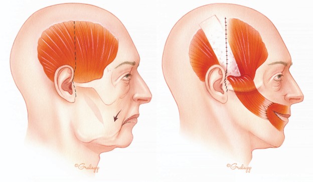 Facial droop with normal face.