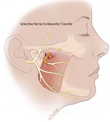 Facial nerves.