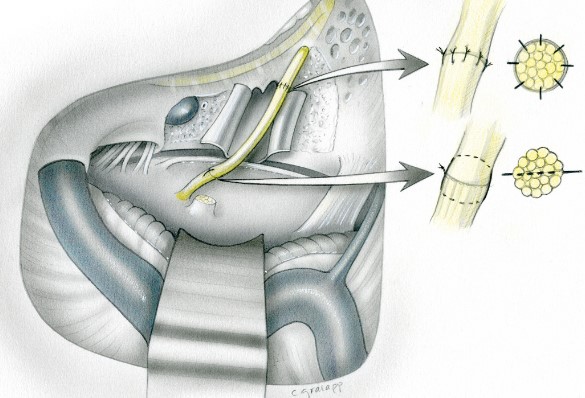 Facial surgery diagram.