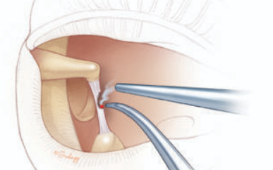 laser stapedotomy.