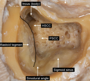 Complete Mastoidectomy.