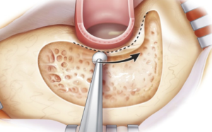 Cortical Mastoidectomy.