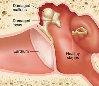 Damaged inner ear.