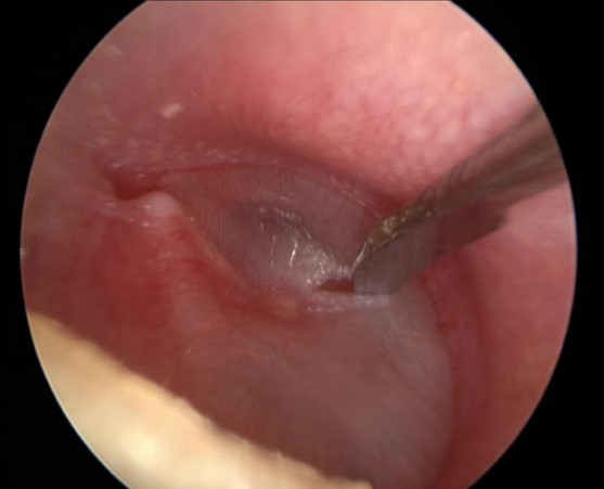 Infected Eardrum