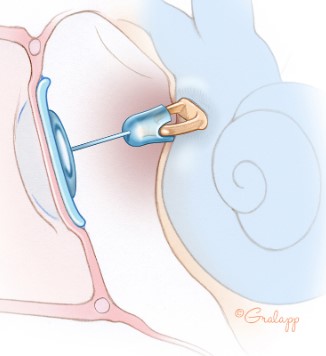 Inner ear procedure.