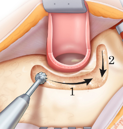 Mastoid Drill.