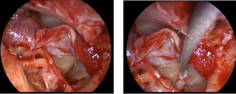 Repairing Eardrum.